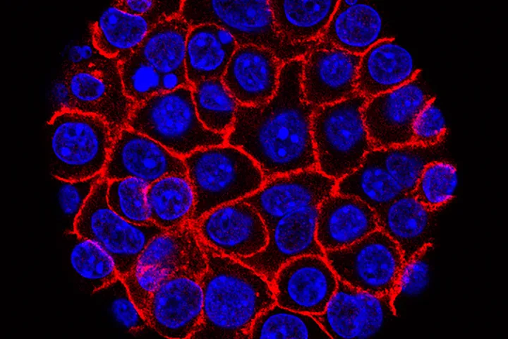 pancreatic cancer