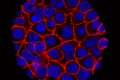 pancreatic cancer